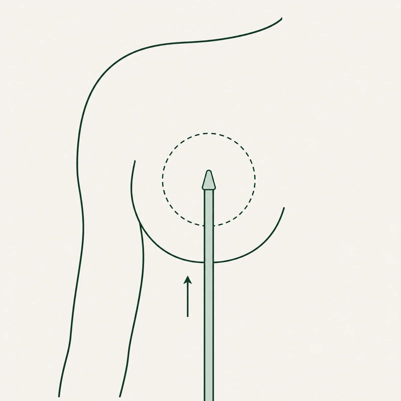 Line illustration of a slim instrument entering from beneath the breast toward a dashed circle marking the planned implant space