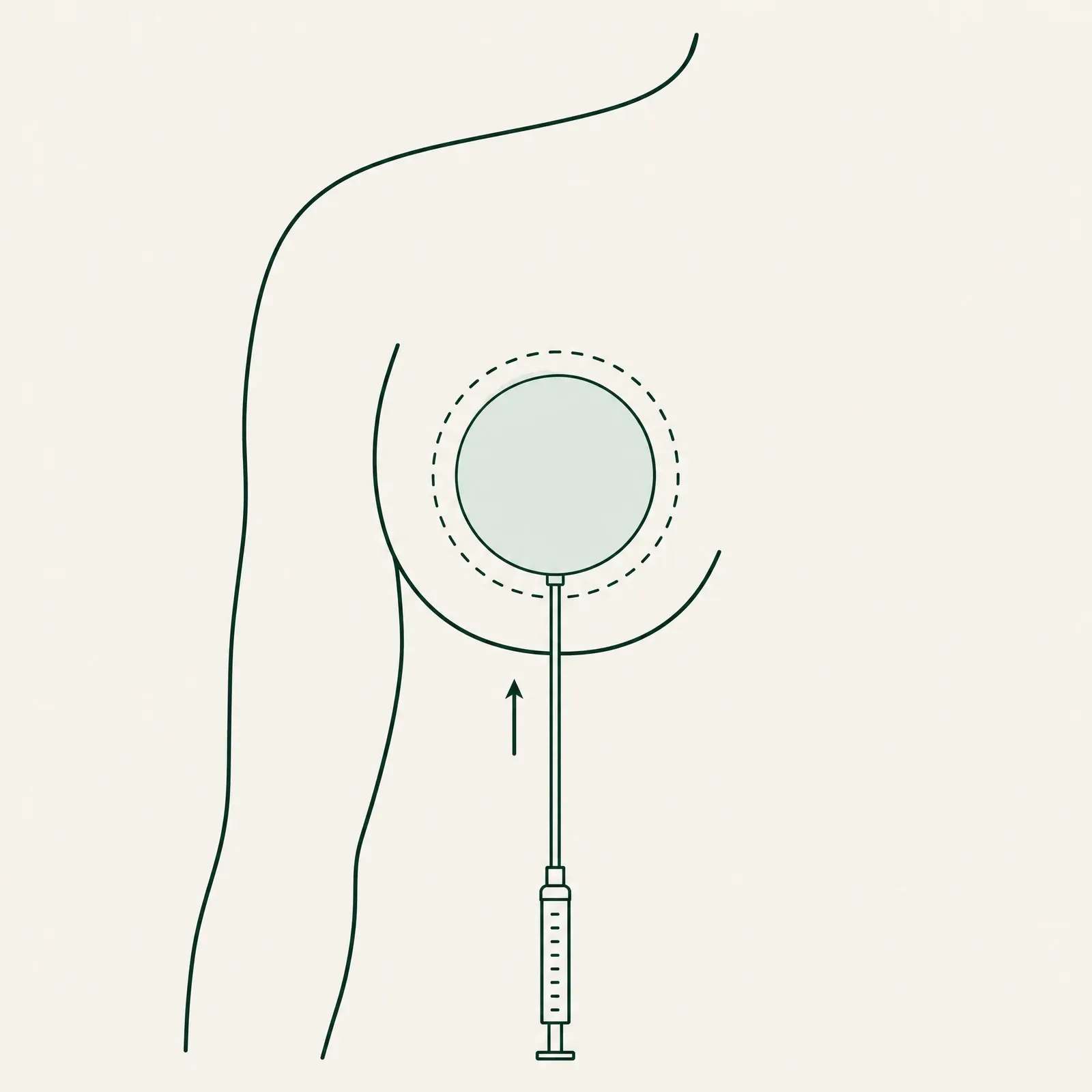 Line illustration of a round balloon filling the planned implant space, inflated through a thin tube from below