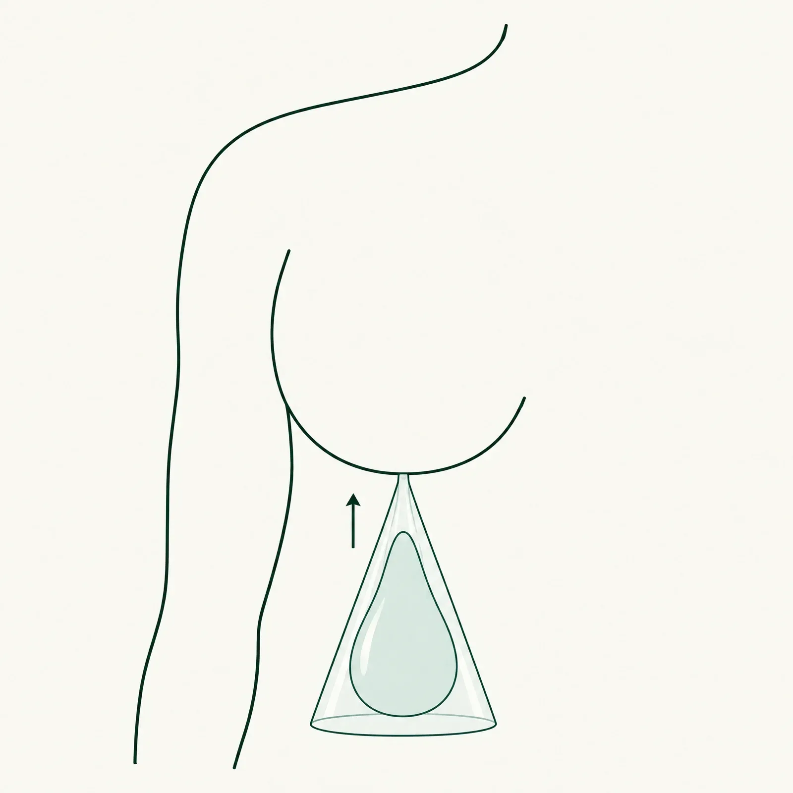 Line illustration of an implant inside a funnel-shaped sleeve whose narrow tip meets the fold beneath the breast